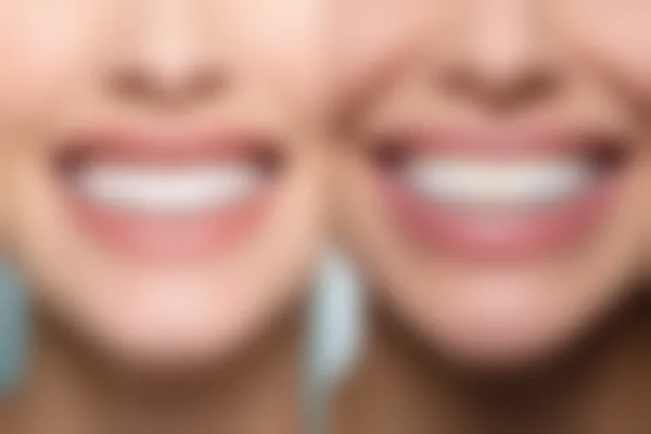 拔掉牙齿后不进行补牙会产生怎样的影响？了解不补牙的后果和风险。