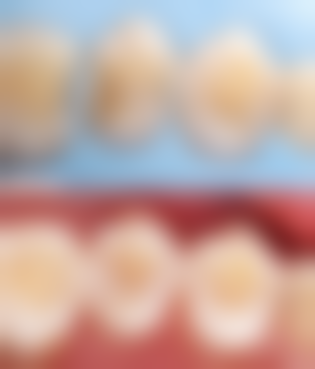 牙髓受损时补牙必须做根管治疗