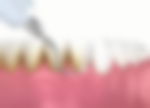 不同类型补牙材料的差价情况