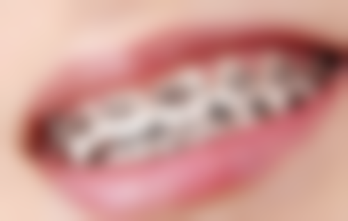 拔牙多久之后可以吃东西：拔牙后1 - 2天的饮食注意事项