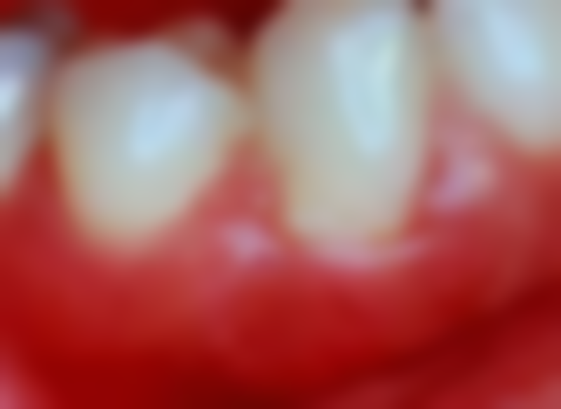 拔牙多久才不会出血？一般30分钟左右基本止血，24 - 48小时内逐渐完全停止！ 