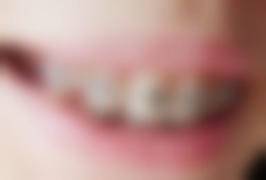 注重口腔卫生是关键