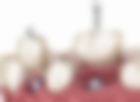 多数情况需要补牙的原因