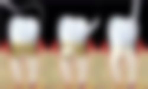 根管治疗后旁边的牙齿痛是怎么回事？可能器械操作不当