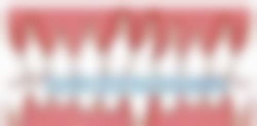 恒牙期：12岁以后，全方面矫正正当时