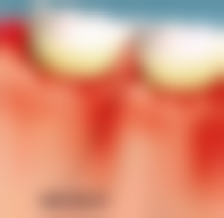 物理治疗缓解牙龈肿痛