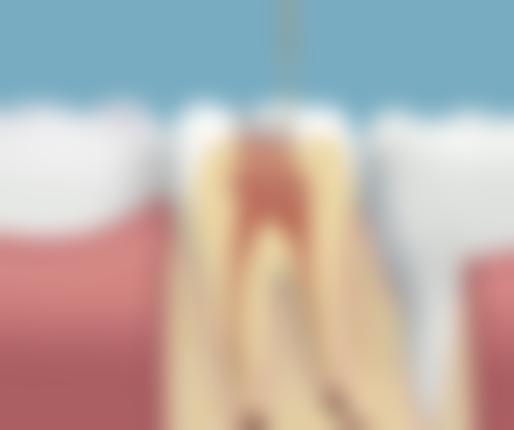 全瓷牙加瓷是什么意思?它指修复全瓷牙问题时加瓷层，含方法且强调需专业操作！ 