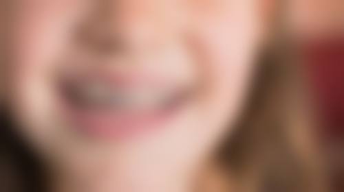 自己洗牙结石的方法在家能不能洗牙？不建议但可尝试超声波洁牙器，专业洗牙更靠谱！ 