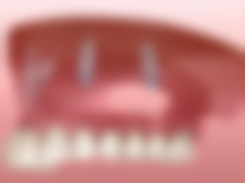 二次根管治疗为什么成功几率低之患者自身因素