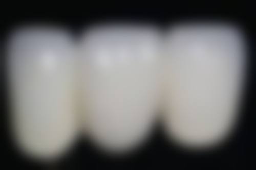 影响老年人种植牙的因素