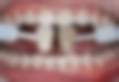 烤瓷牙可以过高考安检吗？需分安检门和金属探测仪情况，有对应办法，还可开证明！ 