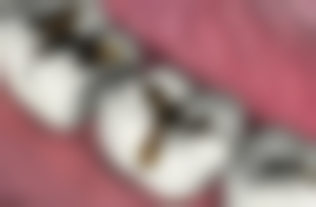 备孕时候拔牙有没有影响？如何正确应对