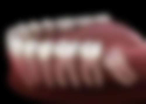 牙齿矫正器是怎么戴的？活动矫正器的佩戴要点