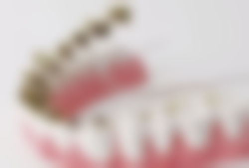 补牙材料150和300区别大吗?耐用程度差异