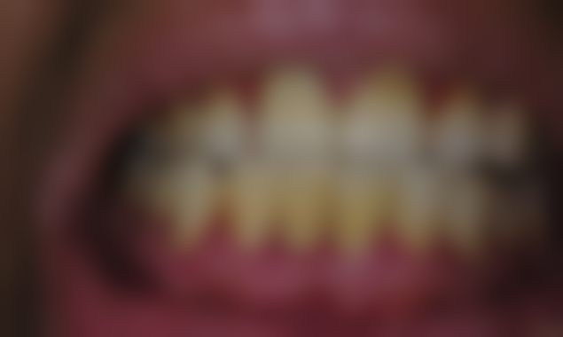 补牙后牙齿敏感疼痛怎么办？日常护理、专业治疗、药物治疗等方法来帮您缓解！ 