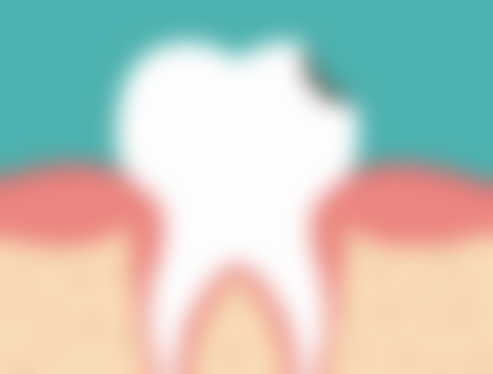 补牙对生活有影响吗？有的！不仅有益恢复功能等，术后也有些注意事项要留意！ 