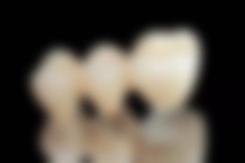 拔牙位置对修复方式的影响