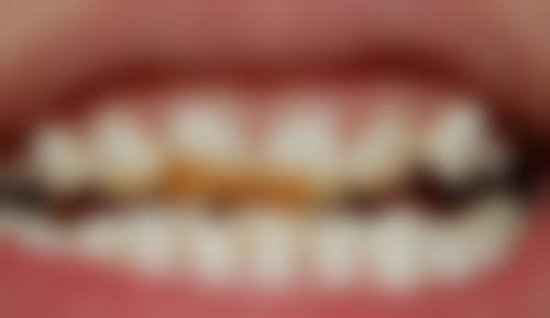 没换牙地包天可以治疗吗？答案是可以，早干预或能防恒牙反颌、促上颌骨发育！ 