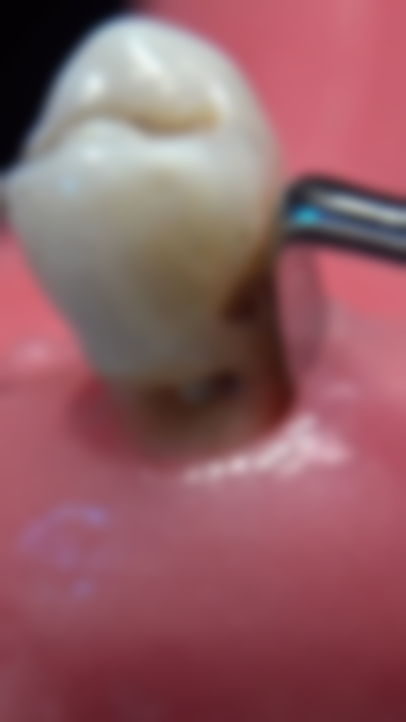 医疗保险能报拔牙吗？2026新规治疗性拔牙可报，报销比例、流程及省钱技巧全揭秘！ 