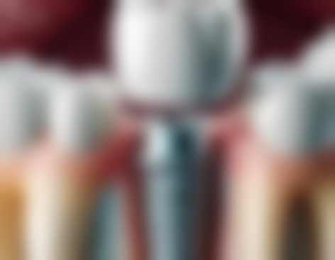 除了种植牙，还有哪些修复方式