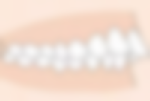 时代天使隐形矫正不影响生活的优势