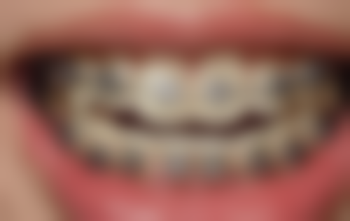 补牙为什么要分三次？主要为确保成效与舒适、保证治疗适应稳定，也因牙齿损伤严重！ 