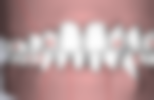 智齿拔牙后不同阶段的疼痛表现