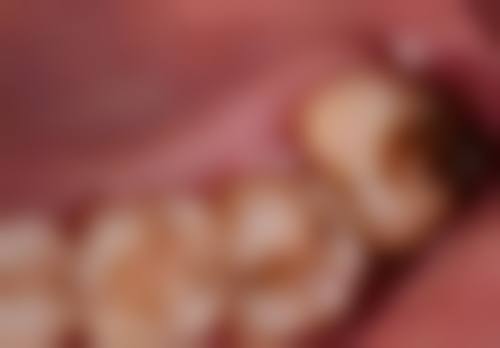 26岁可以做牙齿矫正吗？当然可以！虽矫正时间长但效果好，案例与价格参考都在这！ 