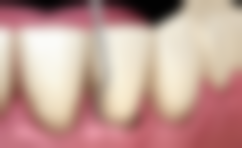 牙齿消炎后多久可以拔牙？不同牙痛原因的情况