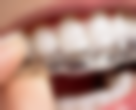 二、昆山爱牙侯婷婷医生擅长项目