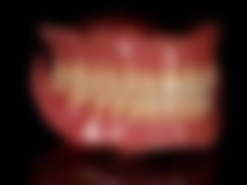 拔牙以后多久种植牙比较好？牙齿拔除原因也有影响