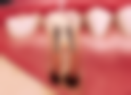 全口种植牙是如何收费的？受种植体数目、品牌、骨量、牙冠材料等因素影响，各地价格有差异！ 