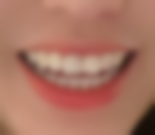 3年在禾禾口腔正畸，牙齿不齐内倾问题解决，张栋梁医生建议超中肯！ 