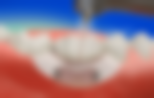 满口种植牙也有一定局限性