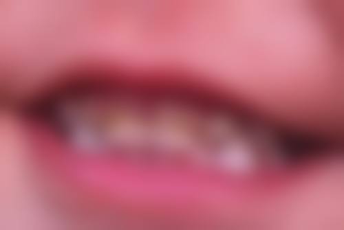 不适合做烤瓷牙时，其他修复方式可选