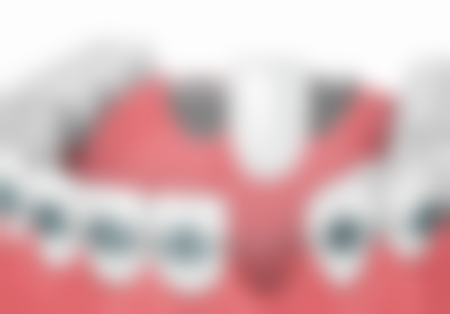 生物陶瓷牙冠材料：新兴的优质材料