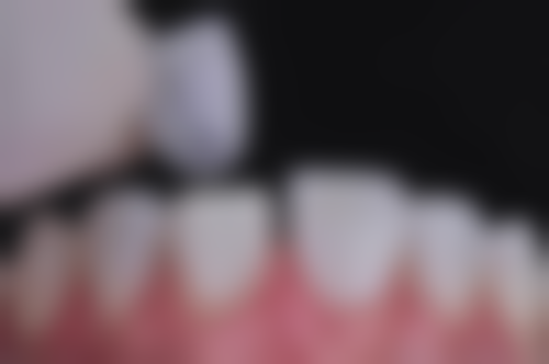 7岁儿童蛀牙需要补牙吗？需根据乳牙恒牙、龋坏程度等情况判断，及时就医很关键！ 