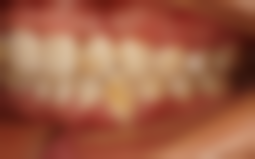 不同类型牙齿（乳牙和恒牙）蛀牙是否需要补牙的判断