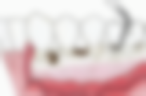 拔牙后的注意事项