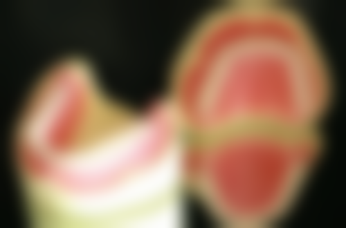 可能诱发牙龈萎缩的设计因素