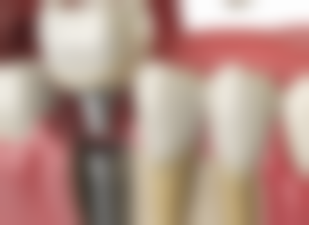 nobel种植牙是哪国家的？它是瑞典品牌，由诺保科公司生产，产品全球闻名！ 