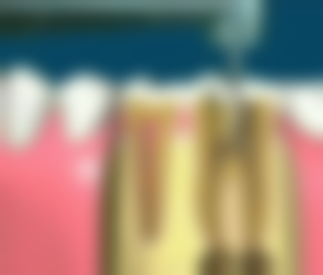 过敏史与牙冠选择