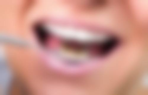 牙体牙髓微痛治疗收费