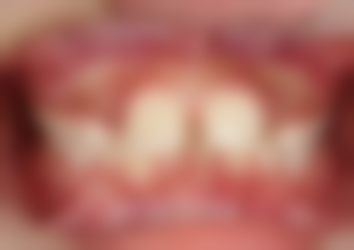 种植牙：现代精良的牙齿修复技术