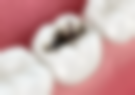 做过根管的牙拔牙麻烦吗？其难度受多种因素影响，具体情况需专业评估并谨慎处理！ 