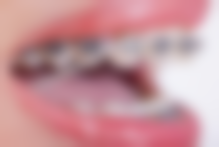 拔牙一周后：慢慢修复正常饮食