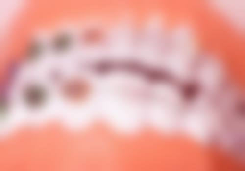 不同情况的全瓷牙冠咬合点高调整方法
