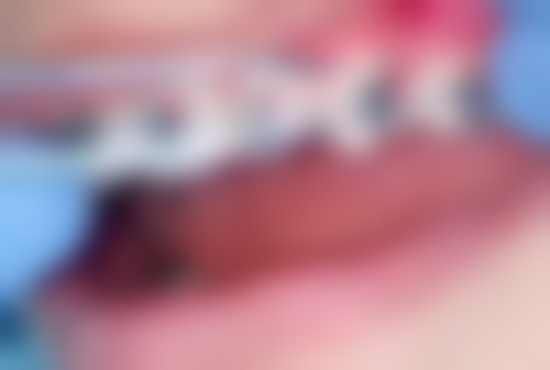 哪些情况需要打桩才能做牙冠