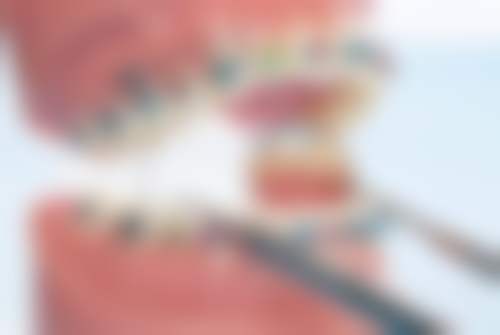 全烤瓷牙的缺点：周期长费用高