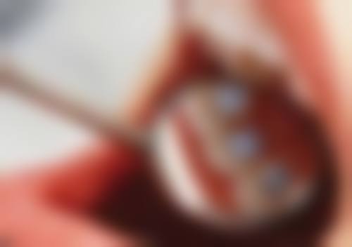 补牙后可以立即洗牙吗？答案是否定的，其中有诸多风险，还需结合材料和恢复情况评估！ 